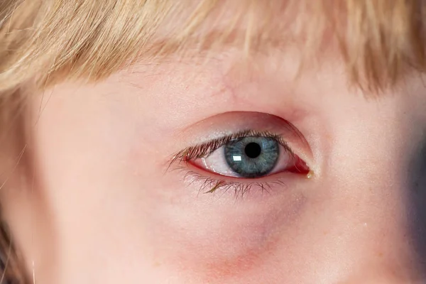 Closeup de olho de sangue vermelho irritado - conjuntivite — Fotografia de Stock