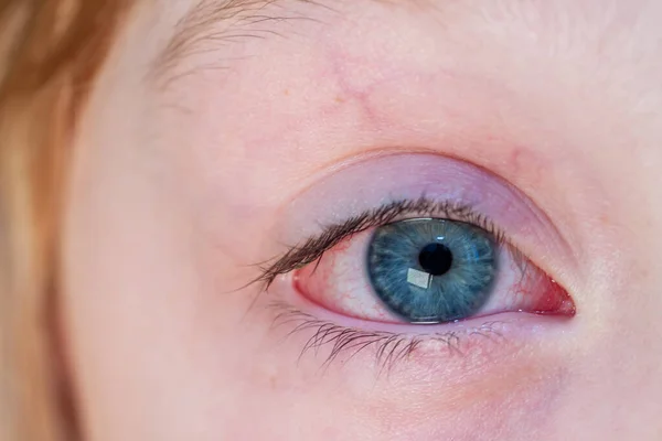 Closeup of irritated red bloodshot eye - conjunctivitis — Stock Photo, Image