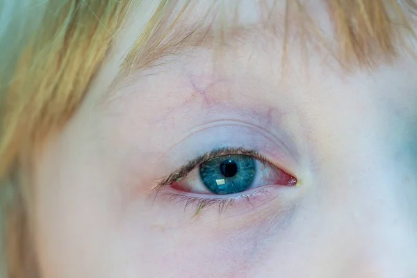 炎症を起こした赤い充血した目の結膜炎のクローズ アップ — ストック写真