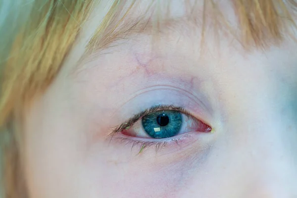 Closeup of irritated red bloodshot eye - conjunctivitis — Stock Photo, Image