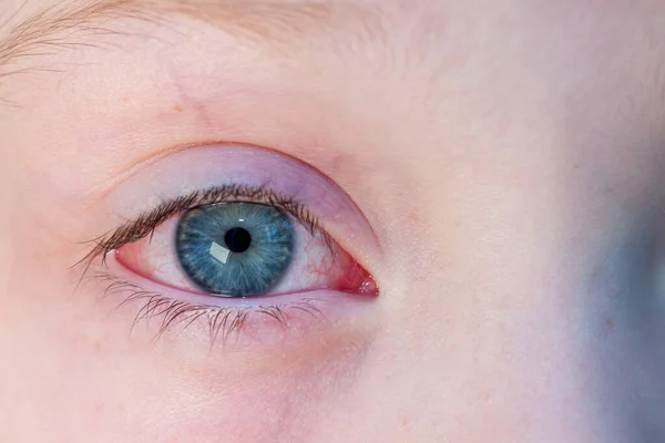 Close-up van geïrriteerde rode bloeddoorlopen ogen - bindvliesontsteking — Stockfoto