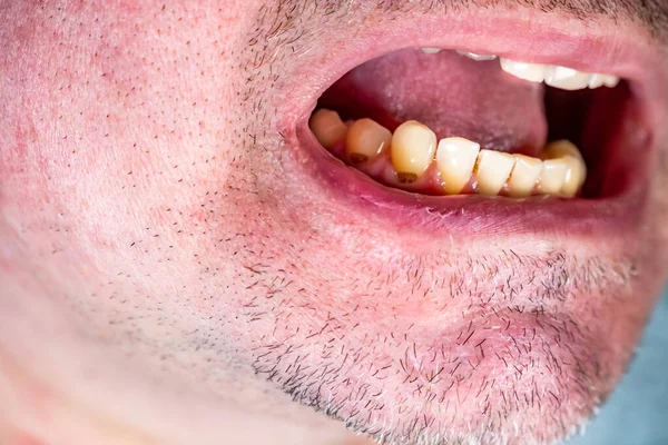 Close up of exposed tooth necks of man — Stock Photo, Image
