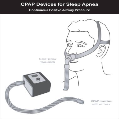 Uyku apnesi, Cpap makine, burun yastık maskesi