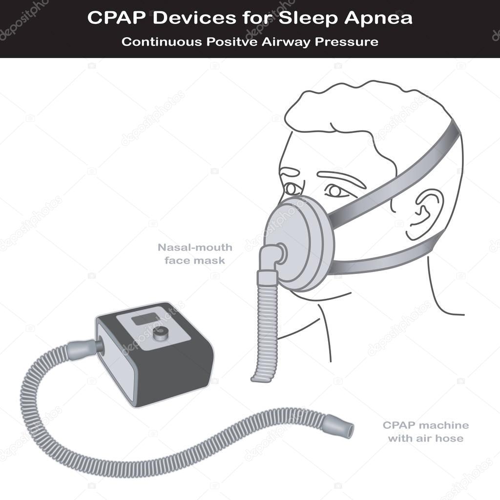 Sleep Apnea, CPAP Machine, Nasal mouth Mask