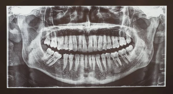 Medische Radiografie Voor Radiologie Van Tandheelkundige Tanden Onderzoek — Stockfoto