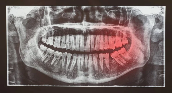 Medizinische Röntgenuntersuchung Oder Röntgenuntersuchung Der Zähne Mit Rotem Punkt Für — Stockfoto