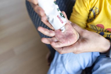 Mother applying white cream for burned hand of her son