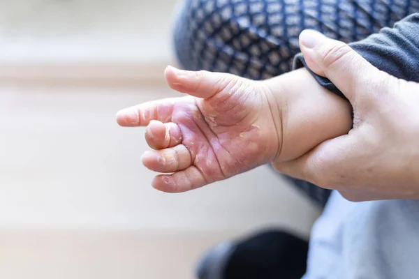 Mão queimada de criança pequena — Fotografia de Stock