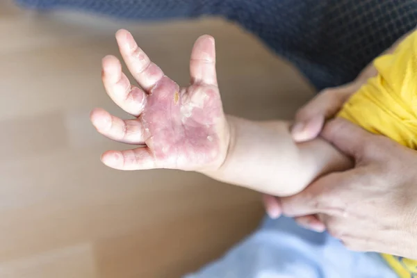 Verbrannte Hand eines kleinen Kindes — Stockfoto