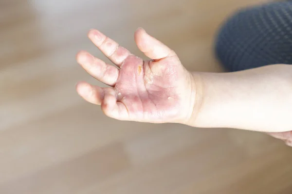 Burned hand of small child — Stock Photo, Image