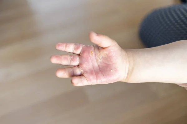 Burned hand of small child — Stock Photo, Image