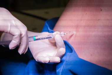 Hamile bir kadın için epidural spinal blok yapan bir doktorun yakın plan görüntüsü.