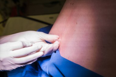 Hamile bir kadın için epidural spinal blok yapan bir doktorun yakın plan görüntüsü.