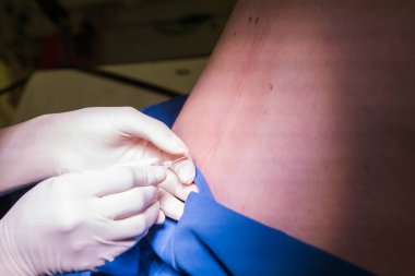 Hamile bir kadın için epidural spinal blok yapan bir doktorun yakın plan görüntüsü.