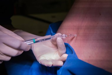 Hamile bir kadın için epidural spinal blok yapan bir doktorun yakın plan görüntüsü.