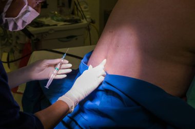 Hamile bir kadın için epidural spinal blok yapan bir doktorun yakın plan görüntüsü.