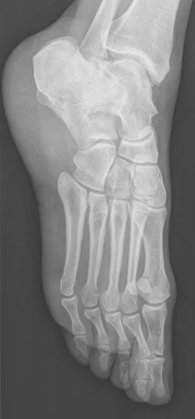 Ray Röntgenbild Mänskliga Kvinnliga Fötter Ben — Stockfoto