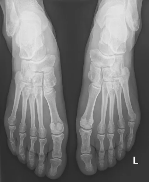 Radiografía Rayos Huesos Humanos Pies Femeninos Significa Lado Izquierdo — Foto de Stock