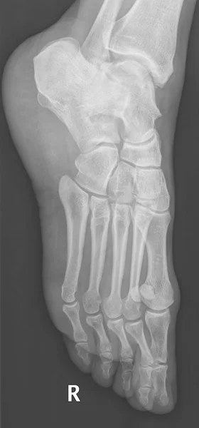 Röntgenaufnahme Menschlicher Weiblicher Fußknochen Bedeutet Rechte Seite — Stockfoto