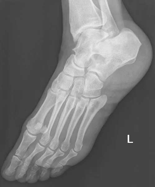 Röntgenaufnahme Menschlicher Weiblicher Fußknochen Bedeutet Linke Seite — Stockfoto