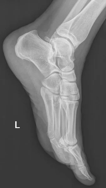 Röntgen Grafisi Insan Kadın Ayak Bones Sol Tarafta Anlamına Gelir — Stok fotoğraf