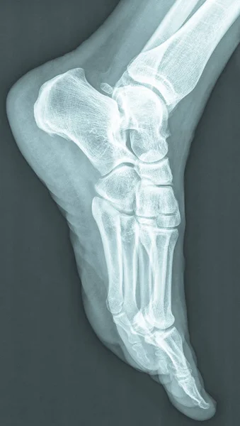 Radiographie Des Des Pieds Féminins Humains — Photo