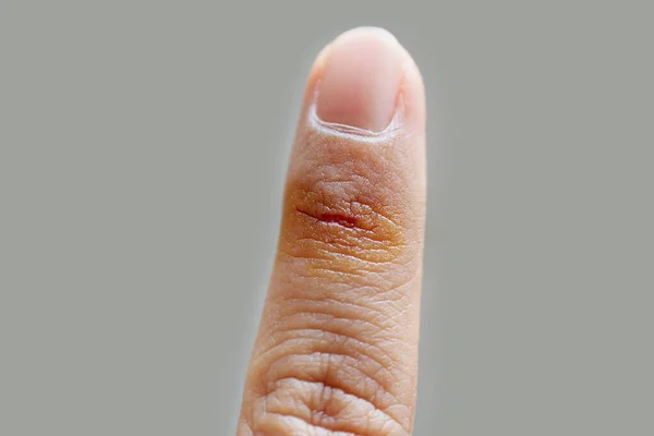 Gri arka planda antiseptik solüsyon ve seçici odaklanma sonucu kesilen parmak yaralanması.