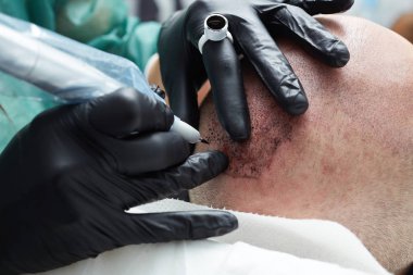 Adam kafasına - tricopigmentation kalıcı makyaj yapma güzellik uzmanı