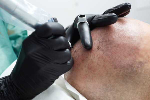 Cosmetologist making permanent makeup on man head - tricopigmentation