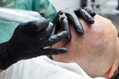 Erkek deri kafa - güzellik uzmanı yapım kalıcı makyaj tricopigmentation uygulama