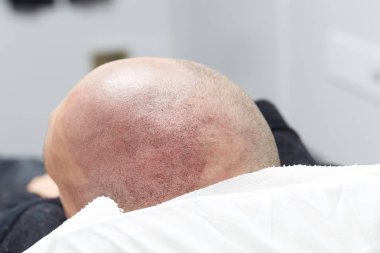 Erkek deri kafa - güzellik uzmanı yapım kalıcı makyaj tricopigmentation uygulama
