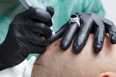 Erkek deri kafa - güzellik uzmanı yapım kalıcı makyaj tricopigmentation uygulama