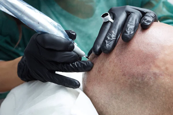 Schoonheidsspecialist maken permanente make-up op het hoofd van de mannelijke huid - tricopigmentation toe te passen — Stockfoto