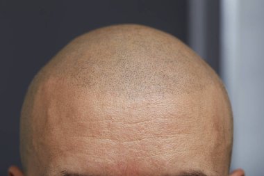 tricopigmentation kalıcı makyaj