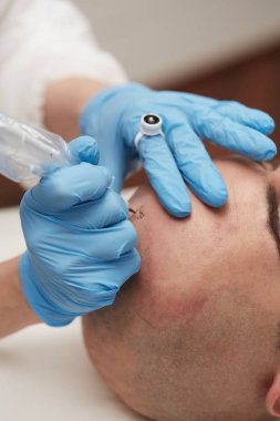 profesyonel dövmeci kalıcı hale getirme tricopigmentation kadar yapmak