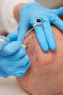 profesyonel dövmeci kalıcı hale getirme tricopigmentation kadar yapmak
