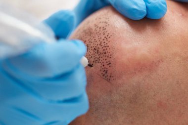 profesyonel dövmeci kalıcı hale getirme tricopigmentation kadar yapmak