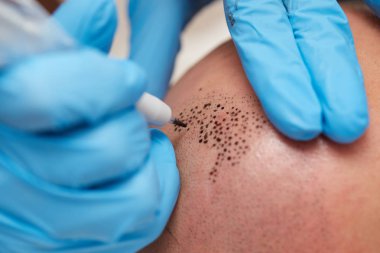 profesyonel dövmeci kalıcı hale getirme tricopigmentation kadar yapmak