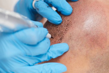 profesyonel dövmeci kalıcı hale getirme tricopigmentation kadar yapmak