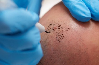 profesyonel dövmeci kalıcı hale getirme tricopigmentation kadar yapmak