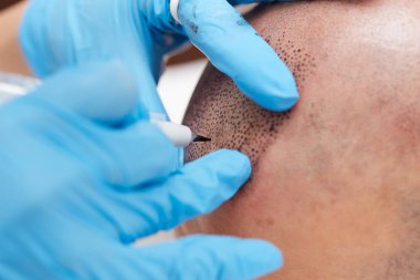 profesyonel dövmeci kalıcı hale getirme tricopigmentation kadar yapmak