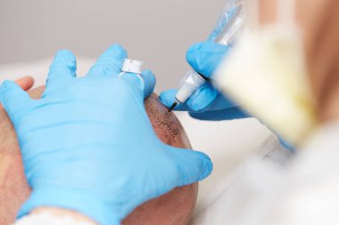 profesyonel dövmeci kalıcı hale getirme tricopigmentation kadar yapmak