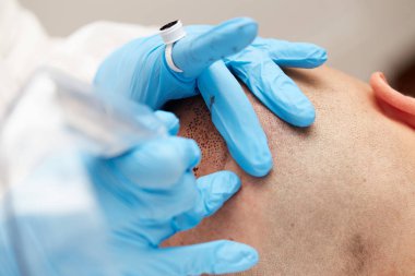 profesyonel dövmeci kalıcı hale getirme tricopigmentation kadar yapmak