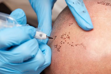 profesyonel dövmeci kalıcı hale getirme tricopigmentation kadar yapmak