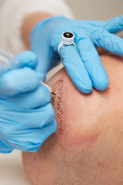Professional tattooist making permanent make up tricopigmentation — Stock Photo, Image