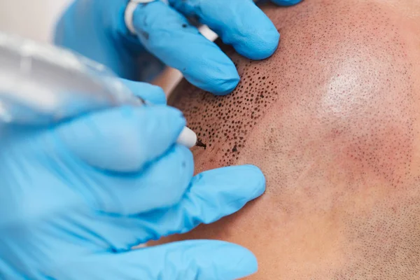 Professional tattooist making permanent make up tricopigmentation — Stock Photo, Image