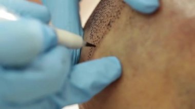 profesyonel dövmeci kalıcı hale getirme tricopigmentation kadar yapmak