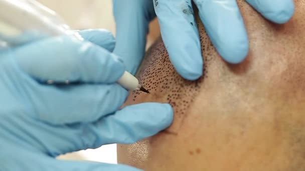 Tätowierer macht Permanent Make-up Trikopigmentierung — Stockvideo