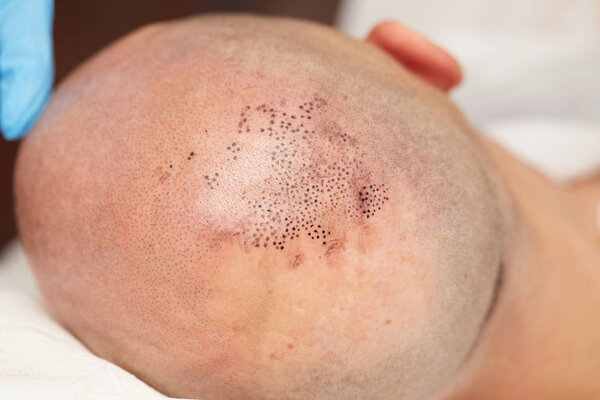 professional tattooist making permanent make up tricopigmentation