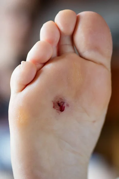 Раненая женская нога. Рана от гвоздя, который пронзил ботинок — стоковое фото